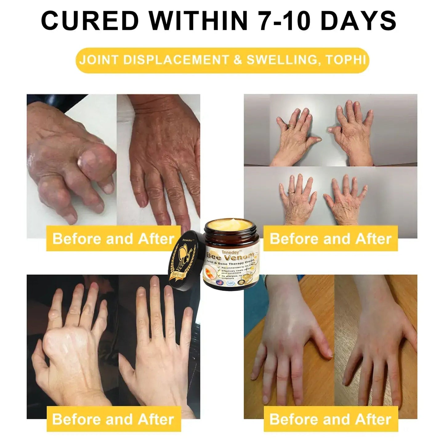 Bee Venom Arthritis Therapy Cream(Specializing in Orthopedic conditions and joint pain & AAOS recommends)