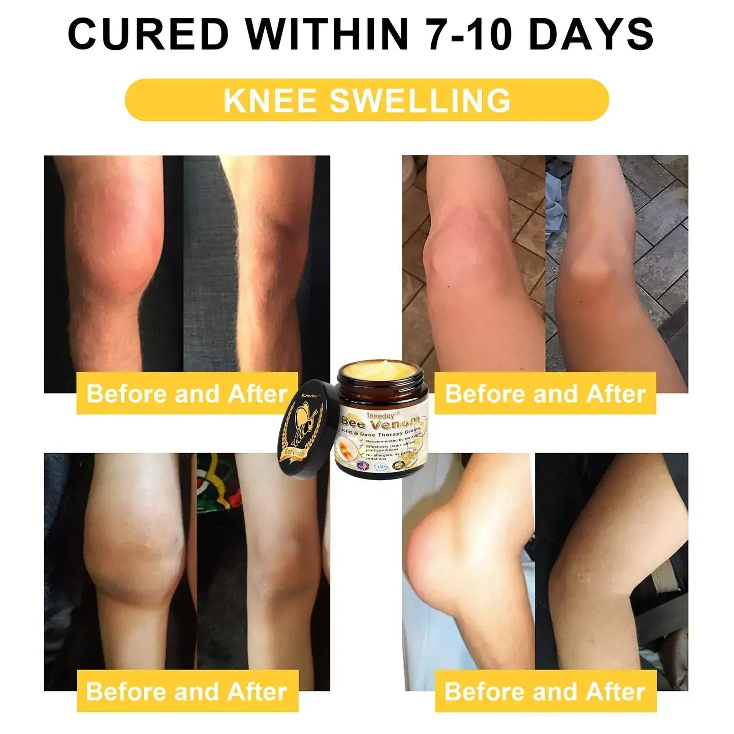 Bee Venom Arthritis Therapy Cream(Specializing in Orthopedic conditions and joint pain & AAOS recommends)
